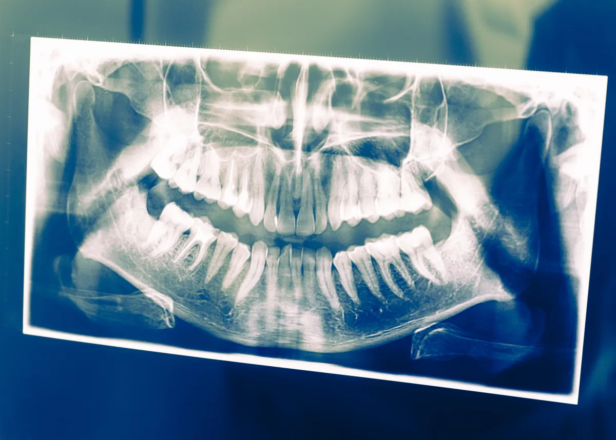 Radiografia panor&acirc;mica odontol&oacute;gica usada na documenta&ccedil;&atilde;o ortod&ocirc;ntica antes do in&iacute;cio do tratamento com aparelho