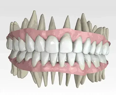 Planejamento digital 3D do tratamento com alinhadores invisíveis na OrthoStudio, em Sorocaba