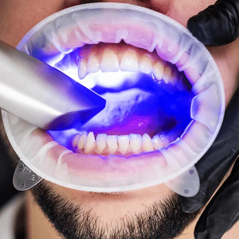 Aplicação de luz LED ativadora de gel clareador durante sessão de clareamento dental em consultório na OrthoStudio, Sorocaba-SP