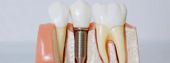 Ilustração de implante dentário de titânio com coroa, tratamento oferecido pela OrthoStudio em Sorocaba