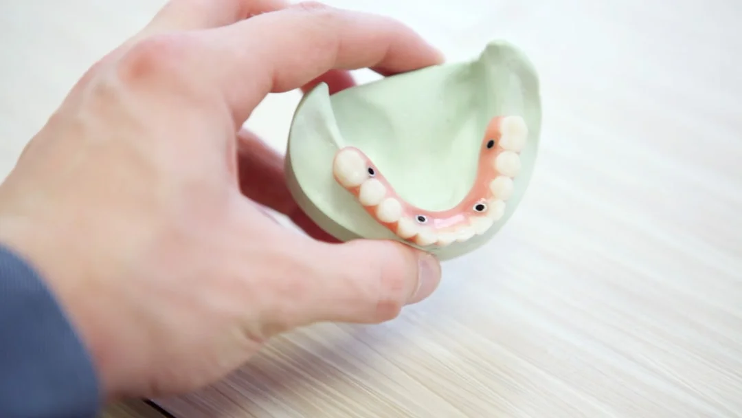 Modelo de implante dentário de titânio utilizado nos tratamentos da OrthoStudio em Sorocaba