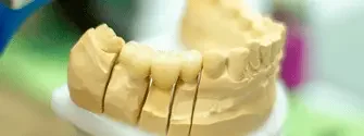 Prótese fixa e coroa dentária cimentada sobre implante, procedimento realizado na OrthoStudio em Sorocaba
